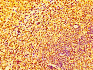 IHC image of CAC13083 diluted at 1:100 and staining in paraffin-embedded human lung cancer performed on a Leica BondTM system. After dewaxing and hydration, antigen retrieval was mediated by high pressure in a citrate buffer (pH 6.0). Section was blocked with 10% normal goat serum 30min at RT. Then primary antibody (1% BSA) was incubated at 4°C overnight. The primary is detected by a biotinylated secondary antibody and visualized using an HRP conjugated SP system.
