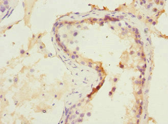 Immunohistochemistry of paraffin-embedded human prostate cancer using CAC13136 at dilution of 1:100
