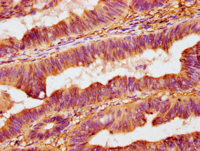 IHC image of CAC13143 diluted at 1:400 and staining in paraffin-embedded human prostate cancer performed on a Leica BondTM system. After dewaxing and hydration, antigen retrieval was mediated by high pressure in a citrate buffer (pH 6.0). Section was blocked with 10% normal goat serum 30min at RT. Then primary antibody (1% BSA) was incubated at 4°C overnight. The primary is detected by a biotinylated secondary antibody and visualized using an HRP conjugated SP system.