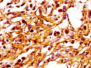 IHC image of CAC13168 diluted at 1:100 and staining in paraffin-embedded human pancreatic cancer performed on a Leica BondTM system. After dewaxing and hydration, antigen retrieval was mediated by high pressure in a citrate buffer (pH 6.0). Section was blocked with 10% normal goat serum 30min at RT. Then primary antibody (1% BSA) was incubated at 4°C overnight. The primary is detected by a biotinylated secondary antibody and visualized using an HRP conjugated SP system.