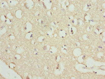 Immunohistochemistry of paraffin-embedded human prostate cancer using CAC13186 at dilution of 1:100