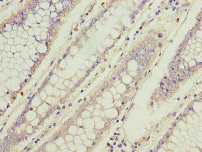 Immunohistochemistry of paraffin-embedded human pancreatic cancer using CAC13214 at dilution of 1:100