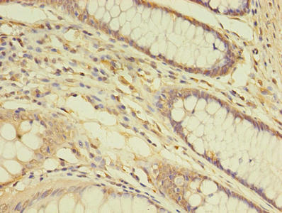Immunohistochemistry of paraffin-embedded human breast cancer using CAC13220 at dilution of 1:100