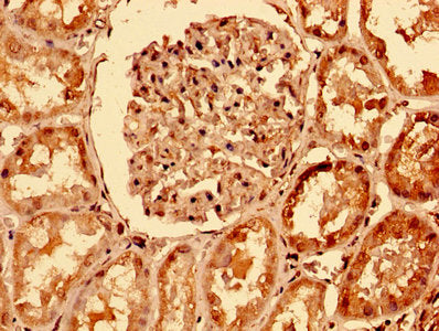 IHC image of CAC13229 diluted at 1:400 and staining in paraffin-embedded human colon cancer performed on a Leica BondTM system. After dewaxing and hydration, antigen retrieval was mediated by high pressure in a citrate buffer (pH 6.0). Section was blocked with 10% normal goat serum 30min at RT. Then primary antibody (1% BSA) was incubated at 4°C overnight. The primary is detected by a biotinylated secondary antibody and visualized using an HRP conjugated SP system.
