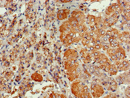 Immunohistochemistry of paraffin-embedded human ovarian cancer using CAC13465 at dilution of 1:100