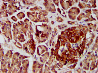 IHC image of CAC13477 diluted at 1:400 and staining in paraffin-embedded human melanoma performed on a Leica BondTM system. After dewaxing and hydration, antigen retrieval was mediated by high pressure in a citrate buffer (pH 6.0). Section was blocked with 10% normal goat serum 30min at RT. Then primary antibody (1% BSA) was incubated at 4°C overnight. The primary is detected by a biotinylated secondary antibody and visualized using an HRP conjugated SP system.