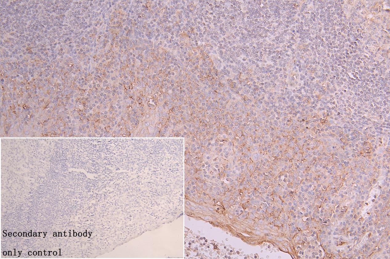 Immunohistochemistry of paraffin-embedded human colon cancer using CAC13567 at dilution of 1:100