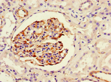 Immunohistochemistry of paraffin-embedded human melanoma using CAC13650 at dilution of 1:100