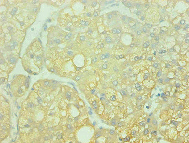 Immunohistochemical of paraffin-embedded human breast cancer using CAC13654 at dilution of 1:200
