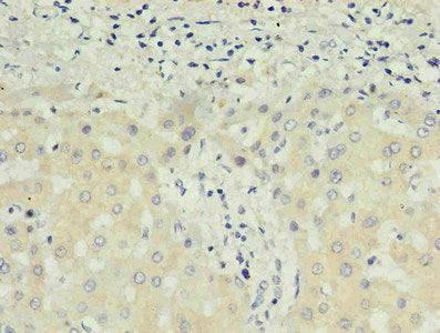 Immunohistochemistry of paraffin-embedded human liver cancer using CAC13677 in 30ug/ml dilute concentrations.