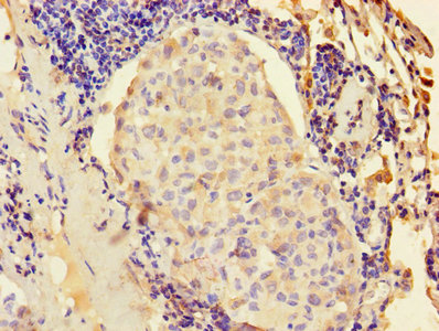 Immunohistochemistry of paraffin-embedded human cervical cancer using CAC13794 at dilution of 1:100