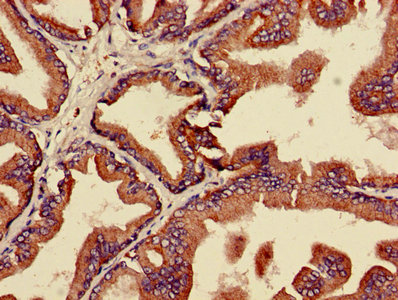 IHC image of CAC13817 diluted at 1:600 and staining in paraffin-embedded human colon cancer performed on a Leica BondTM system. After dewaxing and hydration, antigen retrieval was mediated by high pressure in a citrate buffer (pH 6.0). Section was blocked with 10% normal goat serum 30min at RT. Then primary antibody (1% BSA) was incubated at 4°C overnight. The primary is detected by a biotinylated secondary antibody and visualized using an HRP conjugated SP system.