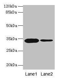 IHC image of CAC13851 diluted at 1:300 and staining in paraffin-embedded human liver cancer performed on a Leica BondTM system. After dewaxing and hydration, antigen retrieval was mediated by high pressure in a citrate buffer (pH 6.0). Section was blocked with 10% normal goat serum 30min at RT. Then primary antibody (1% BSA) was incubated at 4°C overnight. The primary is detected by a biotinylated secondary antibody and visualized using an HRP conjugated SP system.