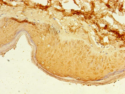 Immunohistochemistry of paraffin-embedded human lung cancer using CAC13856 at dilution of 1:100