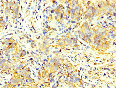 IHC image of CAC13867 diluted at 1:400 and staining in paraffin-embedded human colon cancer performed on a Leica BondTM system. After dewaxing and hydration, antigen retrieval was mediated by high pressure in a citrate buffer (pH 6.0). Section was blocked with 10% normal goat serum 30min at RT. Then primary antibody (1% BSA) was incubated at 4°C overnight. The primary is detected by a biotinylated secondary antibody and visualized using an HRP conjugated SP system.