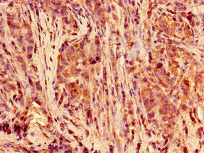 Immunohistochemistry of paraffin-embedded human ovarian cancer using CAC13874 at dilution of 1:100