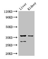 Immunohistochemistry of paraffin-embedded human liver cancer using CAC13881 at dilution of 1:100