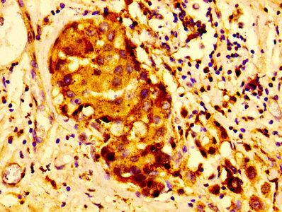 Immunohistochemistry of paraffin-embedded human prostate cancer using CAC13929 at dilution of 1:100