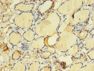 Immunohistochemistry of paraffin-embedded human lung cancer using CAC13957 at dilution of 1:100