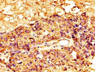 IHC image of CAC14119 diluted at 1:300 and staining in paraffin-embedded human breast cancer performed on a Leica BondTM system. After dewaxing and hydration, antigen retrieval was mediated by high pressure in a citrate buffer (pH 6.0). Section was blocked with 10% normal goat serum 30min at RT. Then primary antibody (1% BSA) was incubated at 4°C overnight. The primary is detected by a biotinylated secondary antibody and visualized using an HRP conjugated SP system.