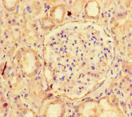 Immunohistochemistry of paraffin-embedded human lung cancer using CAC14127 at dilution of 1:100