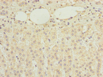 Immunohistochemistry of paraffin-embedded human cervical cancer using CAC14167 at dilution of 1:100
