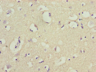 Immunohistochemistry of paraffin-embedded human liver cancer using CAC14182 at dilution of 1:100