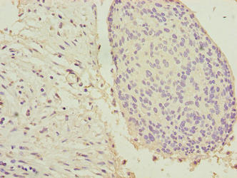 Immunohistochemistry of paraffin-embedded human prostate cancer using CAC14187 at dilution of 1:100