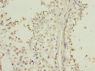 Immunohistochemistry of paraffin-embedded human gastric cancer using CAC14299 at dilution of 1:100