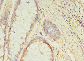 Immunohistochemistry of paraffin-embedded human breast cancer using CAC14334 at dilution of 1:100