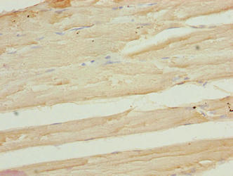 Immunohistochemistry of paraffin-embedded human colon cancer using CAC14351 at dilution of 1:100