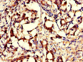 Immunohistochemistry of paraffin-embedded human lung cancer using CAC14375 at dilution of 1:100