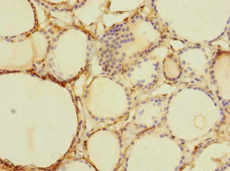 Immunohistochemistry of paraffin-embedded human prostate cancer using CAC14389 at dilution of 1:100