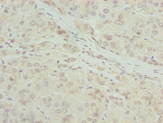 Immunohistochemistry of paraffin-embedded human gastric cancer using CAC14469 at dilution of 1:100