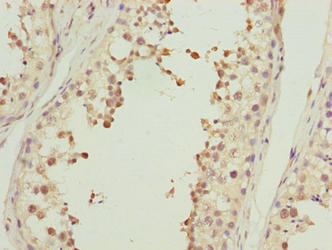 Immunohistochemistry of paraffin-embedded human prostate cancer using CAC14525 at dilution of 1:100