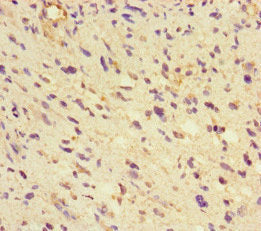 Immunohistochemistry of paraffin-embedded human liver cancer using CAC14536 at dilution of 1:100