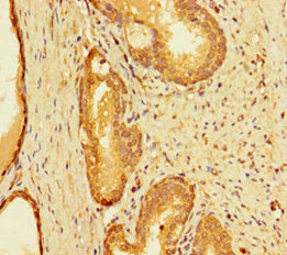 Immunohistochemistry of paraffin-embedded human ovarian cancer using CAC14539 at dilution of 1:100