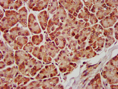 IHC image of CAC14542 diluted at 1:600 and staining in paraffin-embedded human liver cancer performed on a Leica BondTM system. After dewaxing and hydration, antigen retrieval was mediated by high pressure in a citrate buffer (pH 6.0). Section was blocked with 10% normal goat serum 30min at RT. Then primary antibody (1% BSA) was incubated at 4°C overnight. The primary is detected by a biotinylated secondary antibody and visualized using an HRP conjugated SP system.