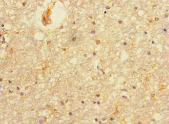 Immunohistochemistry of paraffin-embedded human glioma using CAC14545 at dilution of 1:100