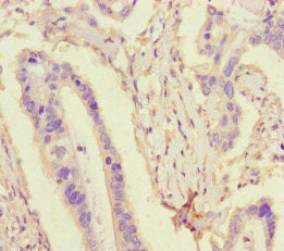Immunohistochemistry of paraffin-embedded human lung cancer using CAC14570 at dilution of 1:100