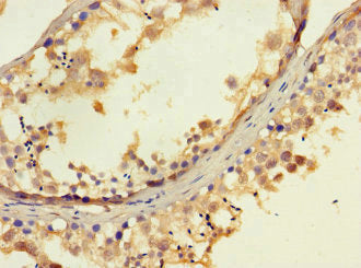 Immunohistochemistry of paraffin-embedded human gastric cancer using CAC14571 at dilution of 1:100