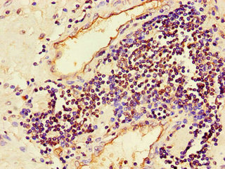 Immunohistochemistry of paraffin-embedded human ovarian cancer using CAC14610 at dilution of 1:100