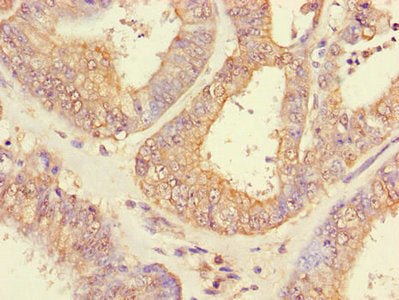 Immunohistochemistry of paraffin-embedded human lung cancer using CAC14620 at dilution of 1:100