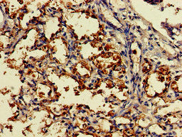 Immunohistochemistry of paraffin-embedded human gastric cancer using CAC14717 at dilution of 1:100