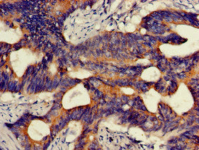 Immunohistochemistry of paraffin-embedded human melanoma using CAC14727 at dilution of 1:100