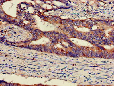 IHC image of CAC14738 diluted at 1:300 and staining in paraffin-embedded human pancreatic cancer performed on a Leica BondTM system. After dewaxing and hydration, antigen retrieval was mediated by high pressure in a citrate buffer (pH 6.0). Section was blocked with 10% normal goat serum 30min at RT. Then primary antibody (1% BSA) was incubated at 4°C overnight. The primary is detected by a biotinylated secondary antibody and visualized using an HRP conjugated SP system.