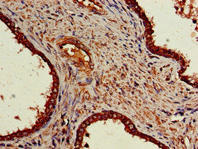 Immunohistochemistry of paraffin-embedded human glioma using CAC14743 at dilution of 1:100