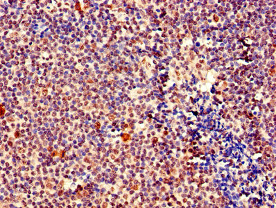IHC image of CAC14775 diluted at 1:400 and staining in paraffin-embedded human melanoma performed on a Leica BondTM system. After dewaxing and hydration, antigen retrieval was mediated by high pressure in a citrate buffer (pH 6.0). Section was blocked with 10% normal goat serum 30min at RT. Then primary antibody (1% BSA) was incubated at 4°C overnight. The primary is detected by a biotinylated secondary antibody and visualized using an HRP conjugated SP system.