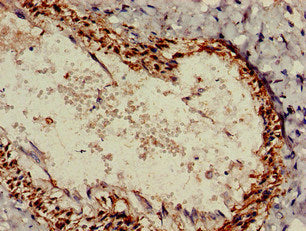 Immunohistochemistry of paraffin-embedded human colon cancer using CAC14811 at dilution of 1:100