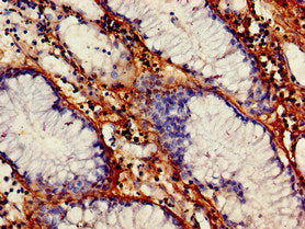 Immunohistochemistry of paraffin-embedded human endometrial cancer using CAC14886 at dilution of 1:100